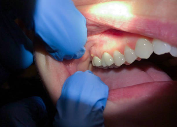 Best Emergency Dental Care for Broken or Chipped Teeth in James City, NC
