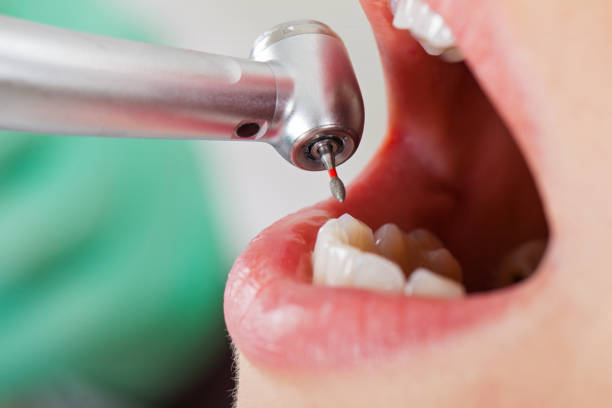 Best Urgent Care for Lost Fillings or Crowns in James City, NC